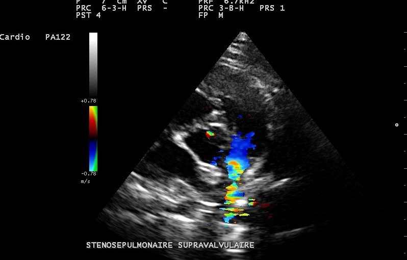 Sténose pulmonaire